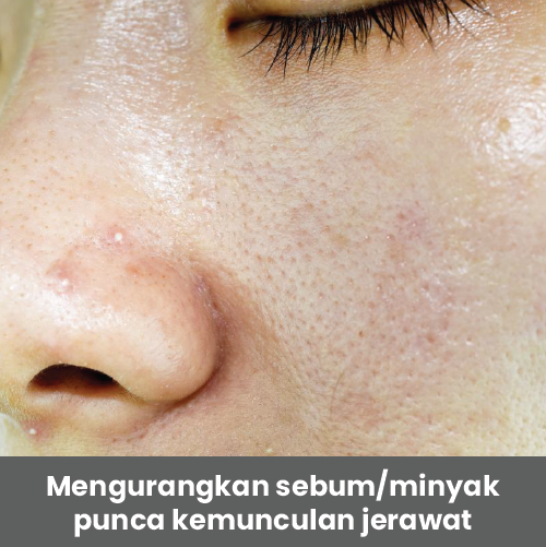 lp acne-03